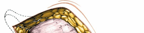 Illustration 24 for Unlocking Every Aspect of the Hip's Surgical Approaches