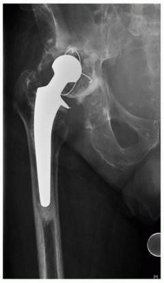 Illustration 2 for Mastering Revision THA: Strategies for Adverse Local Tissue Challenges