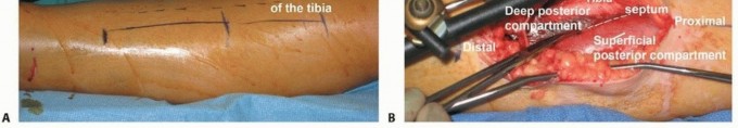 Illustration 16 for Acute Compartment Syndrome: Timely Fasciotomy Explained