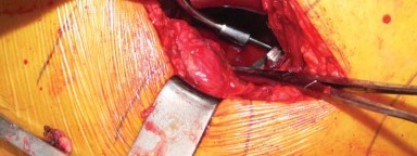 Illustration 43 for Exploring the Ambulatory Surgical Setting for Total Hip Replacement