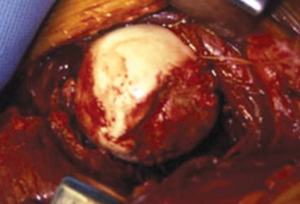 Illustration 9 for Navigating Early THA for Fractures of the Acetabulum