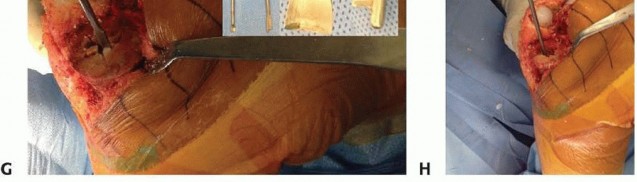 Illustration 12 for Removal of Well-fixed Components: Safe Techniques for Revision TKA