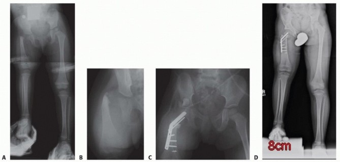 Illustration 30 for Treatment for Congenital Femoral Deficiency: What You Need to Know