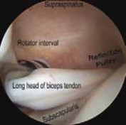 Resolve Long Head Biceps Pain: Advanced Arthroscopic Treatment