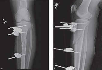 Proximal Tibia Fractures: Nailing Deformities & How to Fix Them