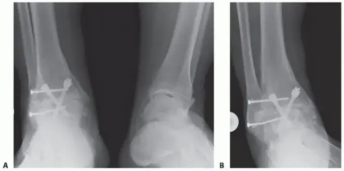 دمج مفصل الكاحل والقدم (تثبيت الكاحل تحت الكاحلي): حل نهائي لآلام القدم المزمنة واستعادة الحركة