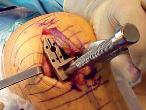 صورة طبية: جراحة استبدال مفصل الركبة الجزئي (UKA): تجنب الأخطاء والاستفادة القصوى في صنعاء مع الأستاذ الدكتور محمد هطيف