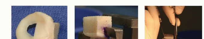Illustration 9 for Symptomatic Knee? Meniscal Transplant for Anterior & Posterior Horns