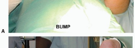 Illustration 6 for Distal Humeral Fractures: When Is Elbow Replacement the Best Option?