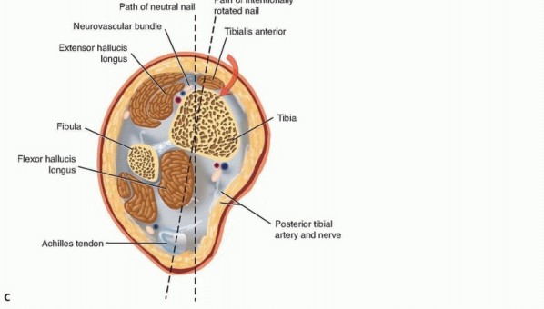 Illustration 3 for Advanced Nailing of the Mature Tibia: Overcoming Complexities