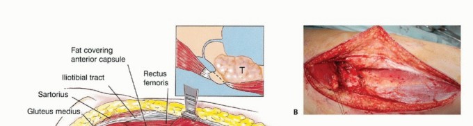 Illustration 19 for Beyond Amputation: Total Femur Resection with Endoprosthetics