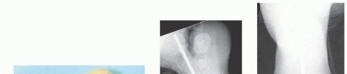 Illustration 18 for Resistant Clubfoot Solved: Posteromedial and Posterolateral Release