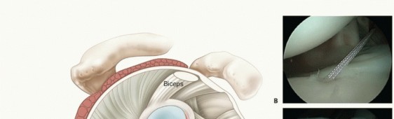 Illustration 3 for Relief for MDI: Expert Treatment of Multidirectional Shoulder Instability