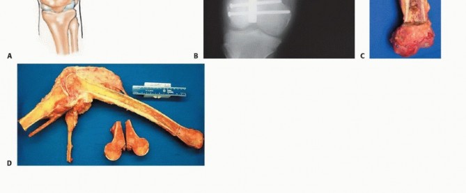 Illustration 2 for Mastering Hip Disarticulation: Through the Hip Joint Capsule
