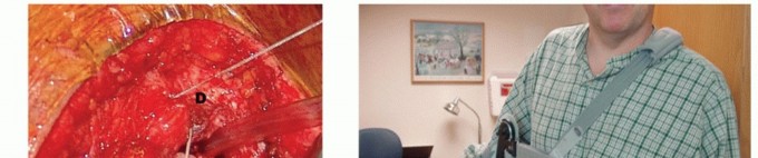 Illustration 25 for Restore Shoulder Function with Latissimus Dorsi Tendon Transfer