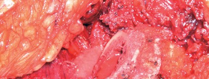 Illustration 24 for Cementless Femoral Stems: Master Indications & Avoid Pitfalls