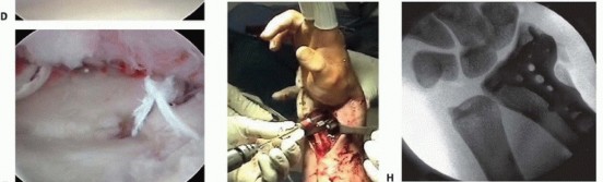 Illustration 15 for Arthroscopic Fixation: Effectively Treating Radial Styloid Fragments