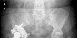 Illustration 5 for Revision Hip Success: Unpacking The Case Title Acetabular Grafting
