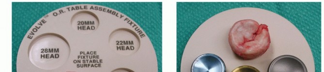 Illustration 15 for Radial Head Arthroplasty: Restoring Elbow Function & Stability