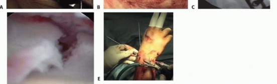 Illustration 14 for Arthroscopic Fixation: Effectively Treating Radial Styloid Fragments