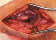 Illustration 16 for Optimal Fixation of the Ankle: Open Reduction & Internal Fixation