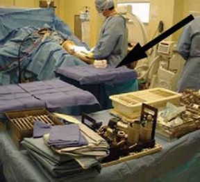 Illustration 8 for Knee Arthrodesis: A Lifelong Knee Solution for Trauma & TKA