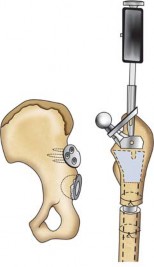 Illustration 134 for Successful Total Hip Replacement in Developmental Dysplasia
