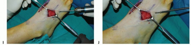 Illustration 26 for Mastering Midfoot Arthrodesis: Protect the Deep Neurovascular Bundle