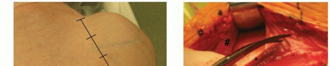 Illustration 11 for Hemiarthroplasty for Proximal: Effective Treatment for Fractures