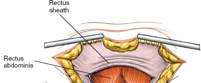 Illustration 8 for Mastering the Posterior Iliac Crest for Bone Graft Harvest