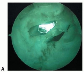 Illustration 16 for Posterior Cruciate Ligament Surgery: Regain Knee Strength & Stability