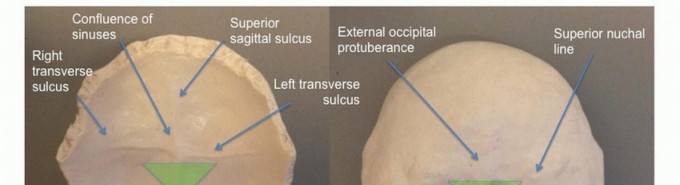 Illustration 4 for Addressing Cervical Spine Instability with Posterior Arthrodesis