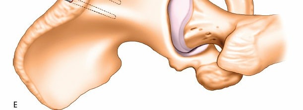 Illustration 25 for Key Approaches for External Fixation: Humerus, Radius, Ulna, Wrist