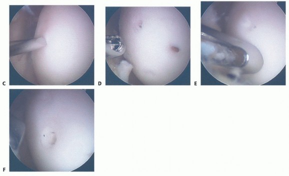 Illustration 28 for Dissecans of the Knee: What's the Difference – OCD vs. AVN?