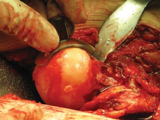 Illustration 33 for Figure Hip Resurfacing: Who Benefits and Who Should Avoid It?