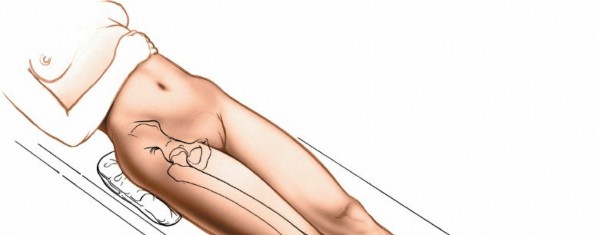 Illustration 13 for Optimal Femoral Approaches: Mastering the Lateral Intermuscular Septum