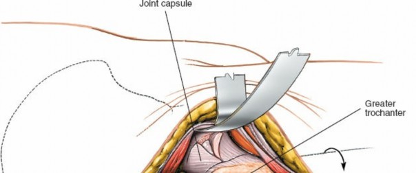 Illustration 138 for Unlocking Every Aspect of the Hip's Surgical Approaches