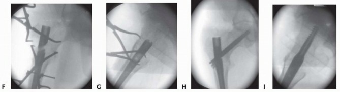 Illustration 18 for Achieve Optimal Femoral Head Fixation with Cephalomedullary Nailing