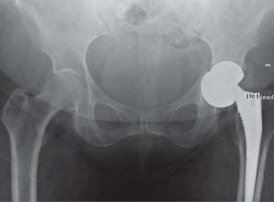 Illustration 39 for Management of Periprosthetic Fractures: An Expert Surgical Guide