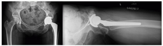 Illustration 4 for Mastering Component Removal: Extended Trochanteric Osteotomy