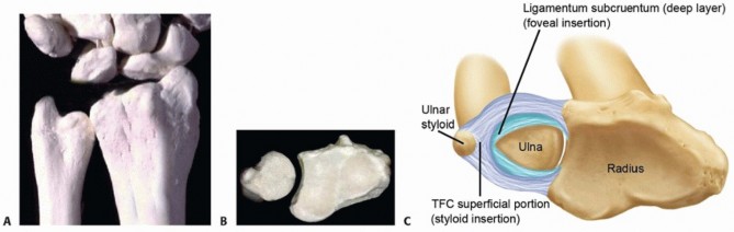 Resection Arthroplasty of the Distal Radioulnar Joint