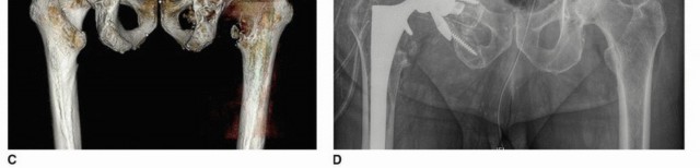 Illustration 15 for Mastering Revision THA: Strategies for Adverse Local Tissue Challenges