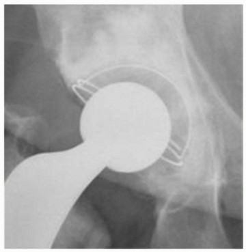 Illustration 28 for Cemented Acetabular Component: Achieving Optimal THA Stability
