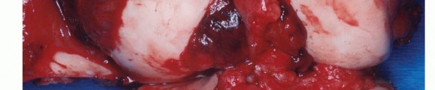 Illustration 14 for Precision Biopsy of Musculoskeletal Tumors for Accurate Diagnosis