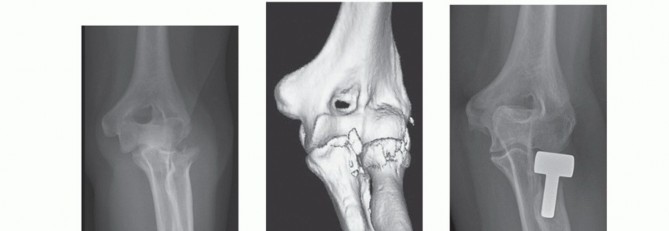 Illustration 3 for Radial Head Arthroplasty: Restoring Elbow Function & Stability
