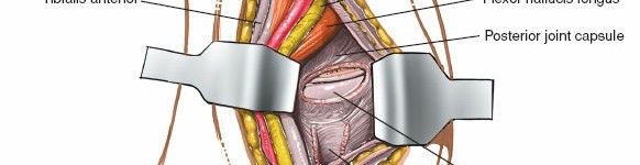 Illustration 28 for Step-by-Step Medial Side of the Ankle Approach Guide
