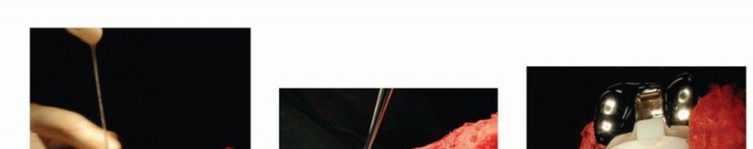 Illustration 9 for Bone Loss Bone Grafting for Challenging Tibial Defects