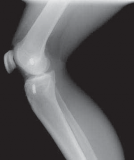 Illustration 6 for Successful Ligament Repair Revision: Fixing Failed ACLs