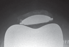 Illustration 28 for Solving Severe Bone Loss: Tantalum for Patellar Reconstruction