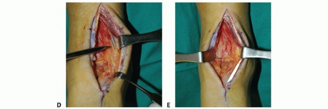 Illustration 3 for Optimize Pain Management with Proximal Ring Block for Ankle Arthrodesis